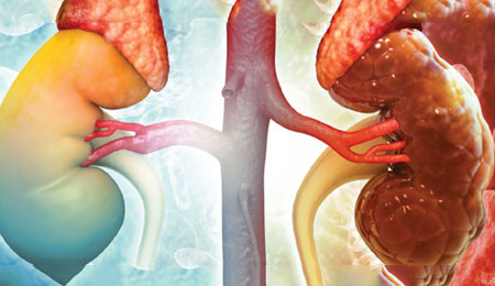 Rapidly Progressing Renal Failure