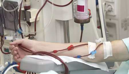 Hemodialysis