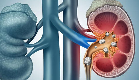 Kidney Stones
