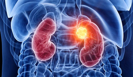Onco Nephrology (Cancer & Kidney)